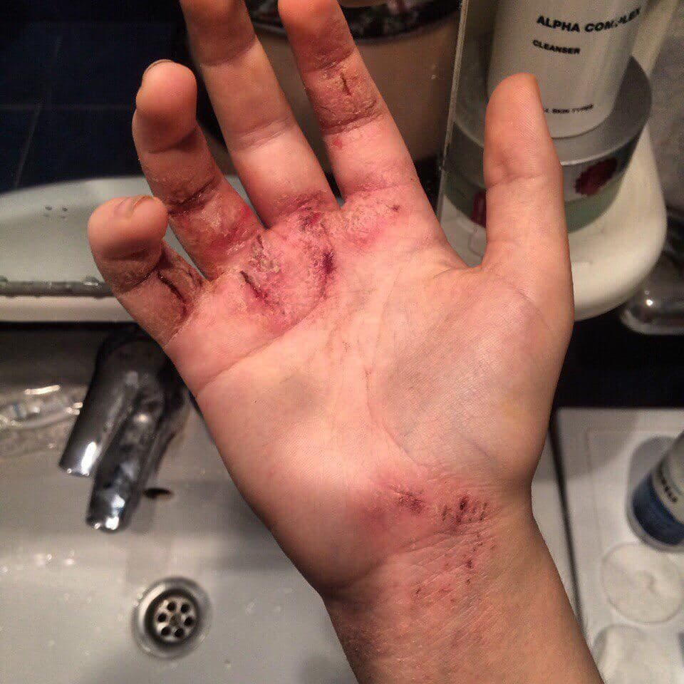 Ksenia's hand disfigurement.
